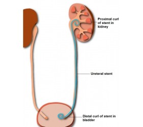 Stent Ureteral descartável de TPU